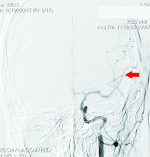 Острый ишемический инсульт у подростка: опыт комбинированного внутрисосудистого тромболизиса
Острый ишемический инсульт у подростка: опыт комбинированного внутрисосудистого тромболизиса