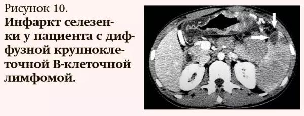 
        Лучевая диагностика при кровотечениях и тромбозах: плюсы и минусы разных методов                    