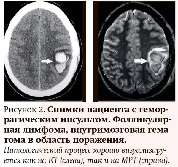 
        Лучевая диагностика при кровотечениях и тромбозах: плюсы и минусы разных методов                    