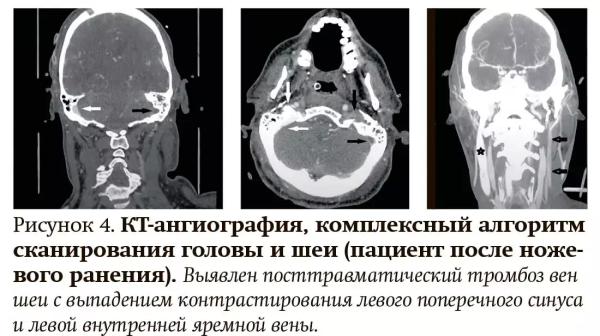 
        Лучевая диагностика при кровотечениях и тромбозах: плюсы и минусы разных методов                    